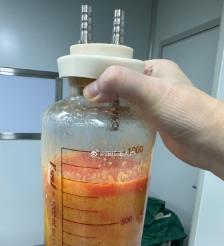 高安水动力吸脂手术要做多久？